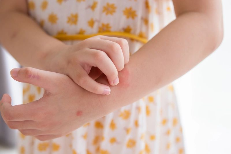 bunda wajib tahu ini cara atasi gigitan serangga pada si kecil 80080