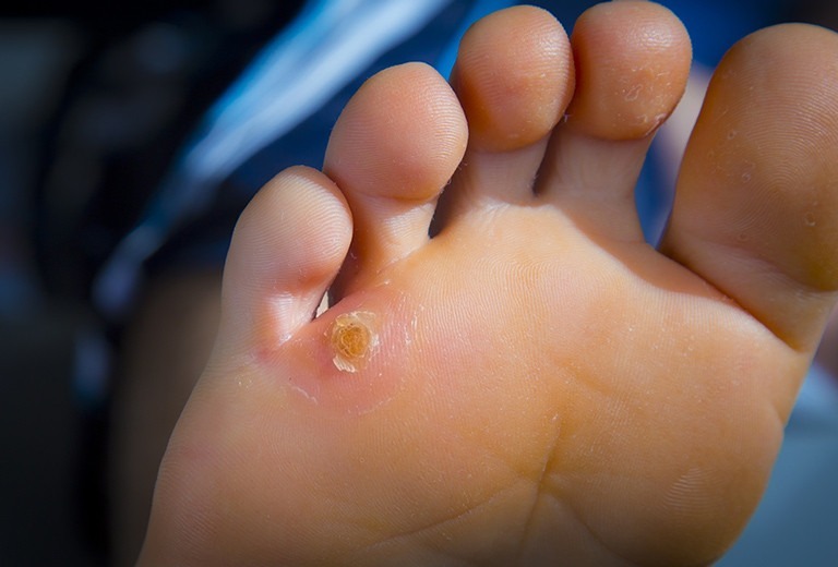catat ini 10 cara lenyapkan kapalan di kaki dengan mudah 66177