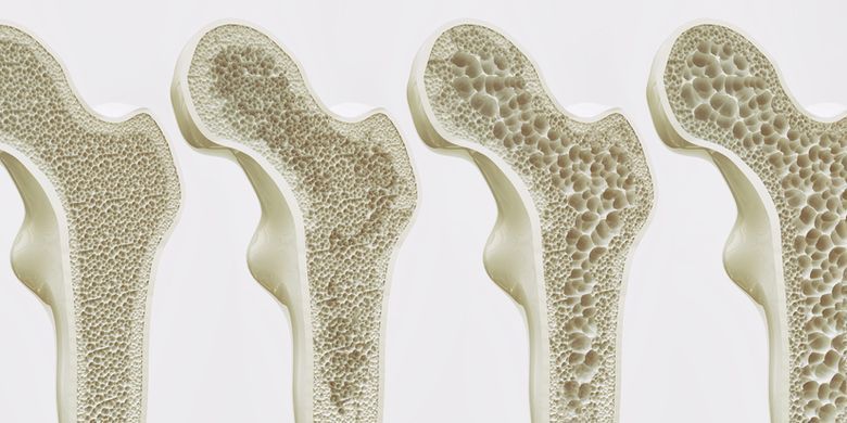 catat ini empat sumber makanan dan minuman yang wajib di hindari guna cegah osteoporosis 64018