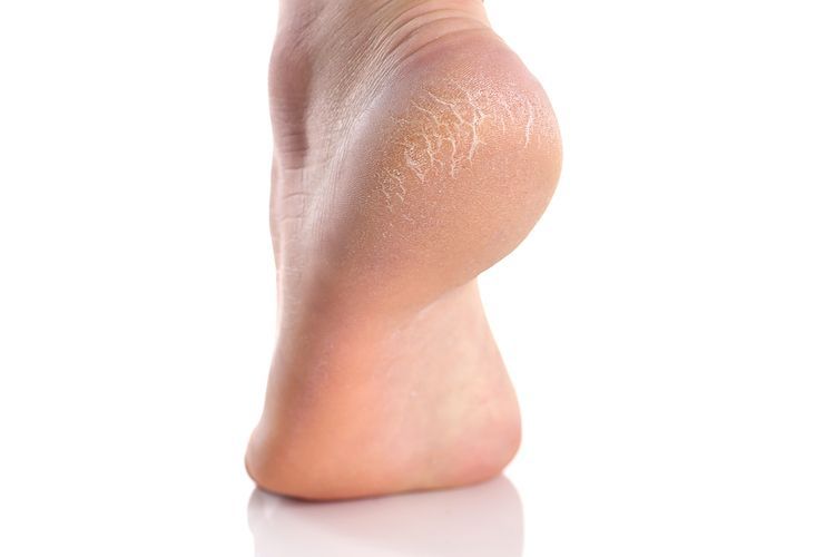 catat ini sederet cara ampuh hilangkan pecah pecah di kaki 78745