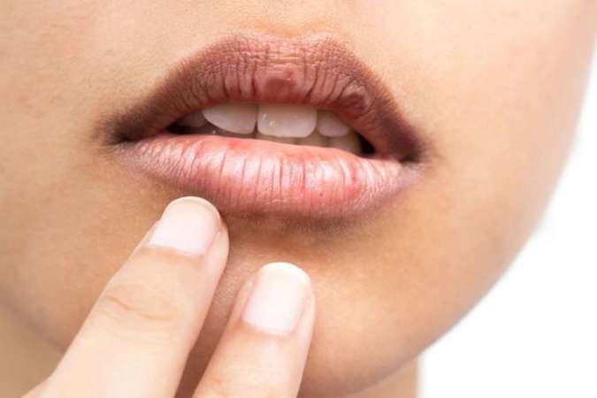 catat sederet makanan ini ampuh atasi bibir pecah pecah 68925