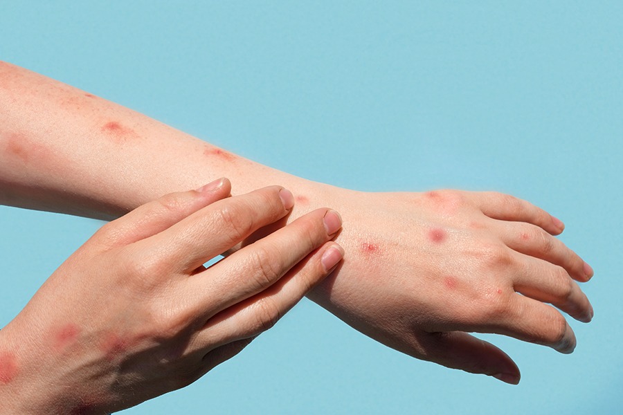 dinas kesehatan temukan pasien penyintas hiv suspek cacar monyet di cianjur 65977