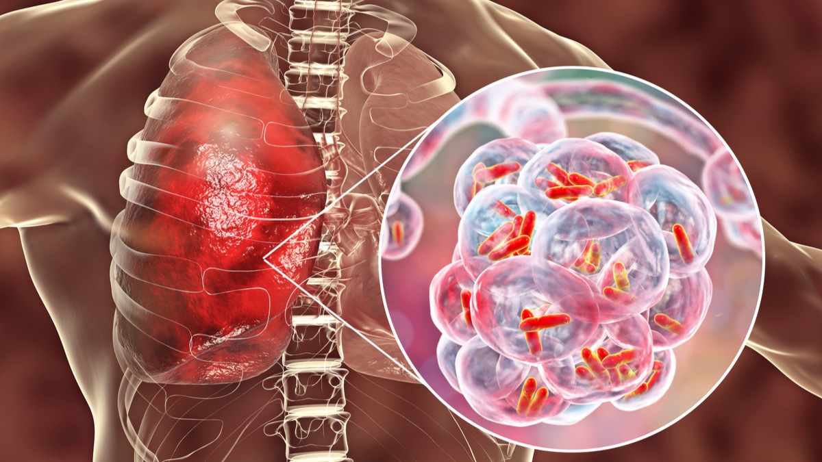 inilah makanan yang harus dihindari bagi penderita pneumonia 67294