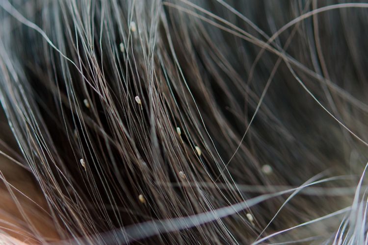 mengganggu ini 7 cara menghilangkan kutu rambut 62096