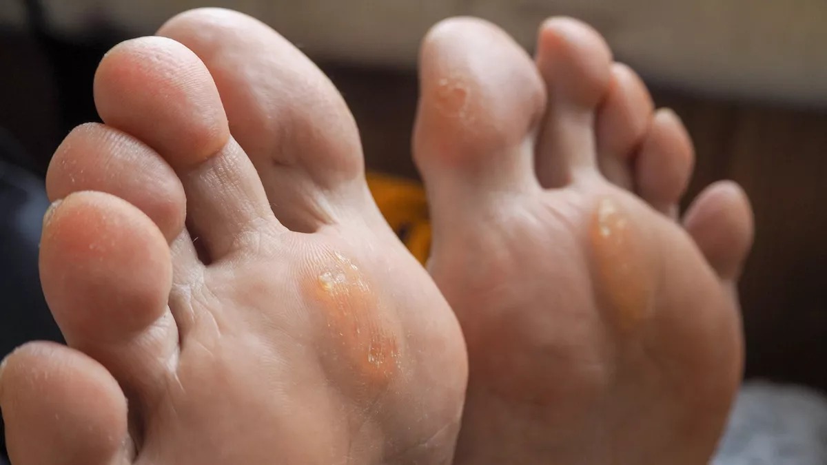 risih kaki kapalan ini sederet cara rumahan yang ampuh mengatasinya 75339