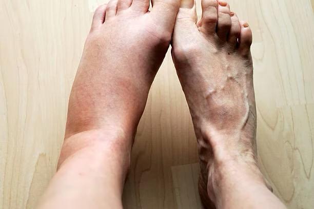 tak banyak yang tahu ini 10 penyebab kaki bengkak dan cara mengobatinya 60430