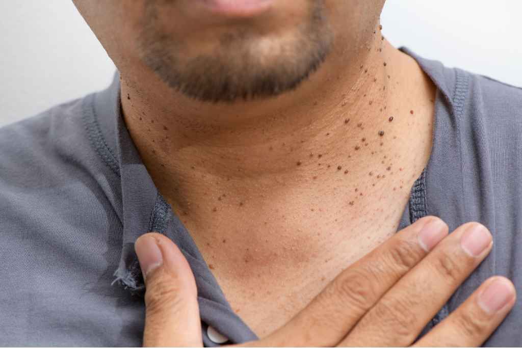 tak banyak yang tahu ini sederet penyebab skin tag di tubuh 68385