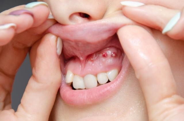 waspada ini 5 penyebab kista mulut yang sering diabaikan 68086