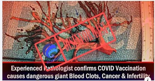 berita hoax gambar gumpalan darah akibat vaksin covid 19 54491