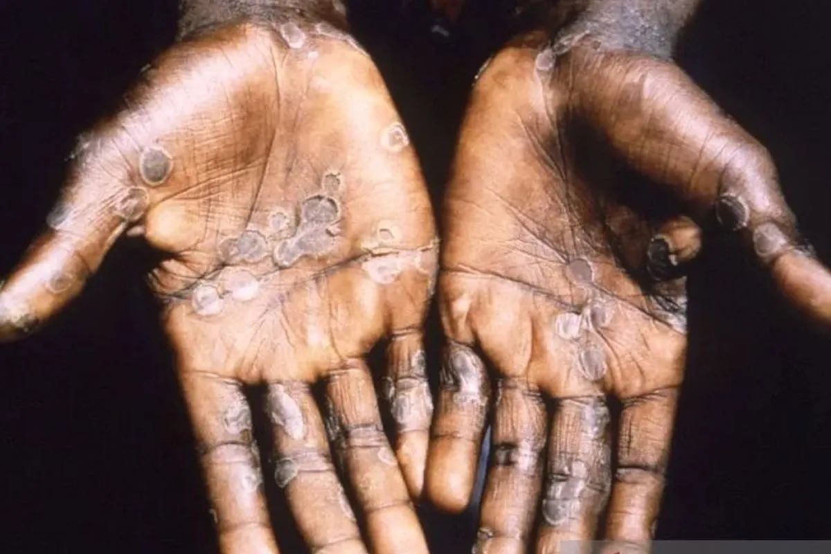 dinkes dki kasus monkeypox di ibu kota 42 orang 66620
