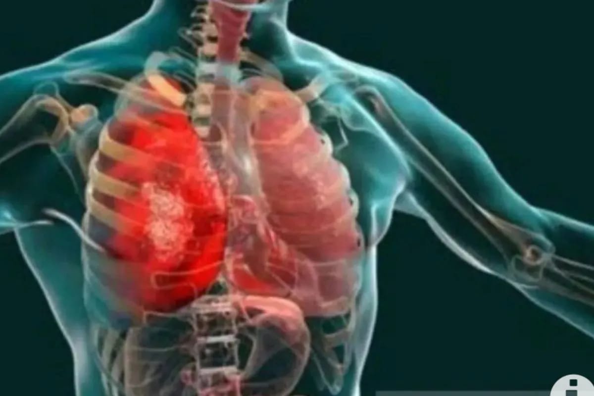 dinkes dki sosialisasikan 3 cara cegah pneumonia pada anak 67337